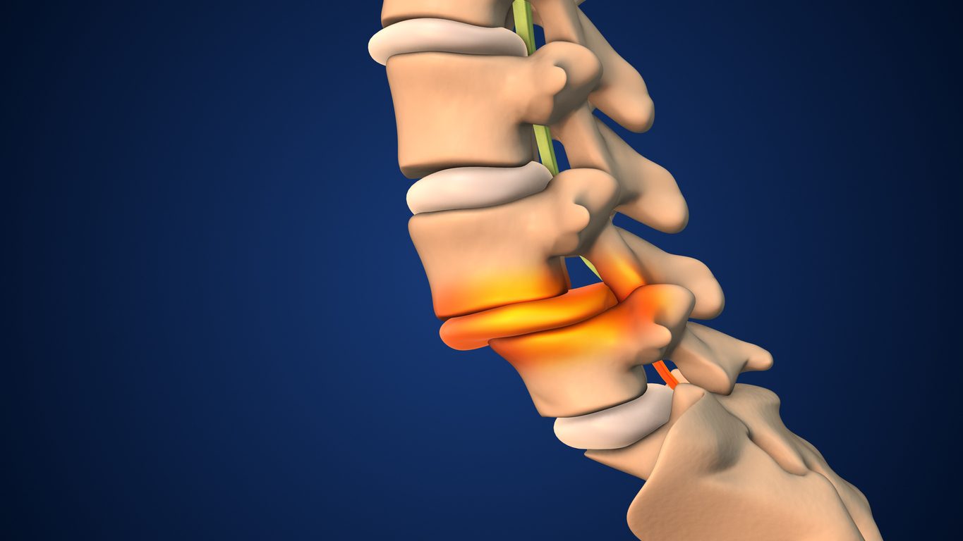 Hernia de disc